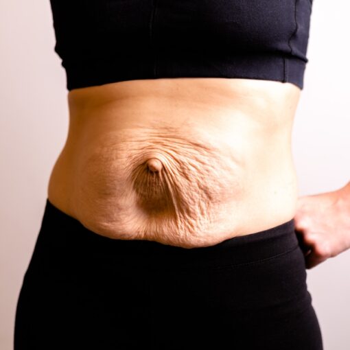 Cropped Woman Dressed In Black Top And Black Leggings.diastasis And Umbilical Hernia After Pregnancy
